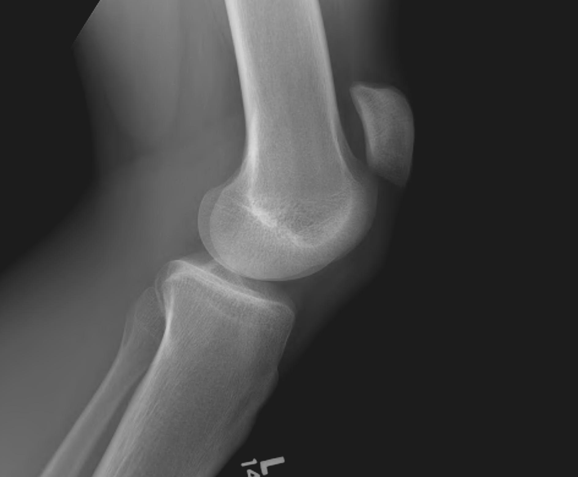 Patella Tendon Rupture